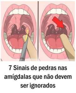 7 Sinais de pedras nas amígdalas que não devem ser ignorados