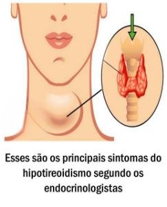 Esses são os principais sintomas do hipotireoidismo segundo os endocrinologistas