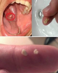 Você sabe o que são aquelas bolinhas fedidas que aparecem na garganta? A resposta pode te surpreender
