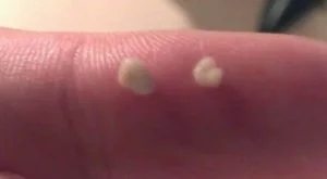 Você sabe o que são aquelas bolinhas fedidas que aparecem na garganta? A resposta pode te surpreender